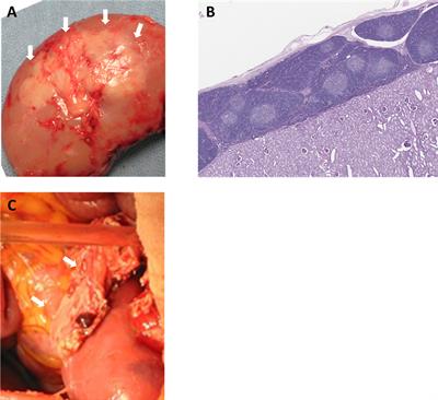 Progress in Xenotransplantation: Immunologic Barriers, Advances in Gene Editing, and Successful Tolerance Induction Strategies in Pig-To-Primate Transplantation